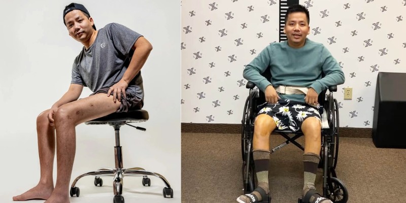 Nam Youtuber chi hàng tỷ đồng để kéo dài chân 15cm